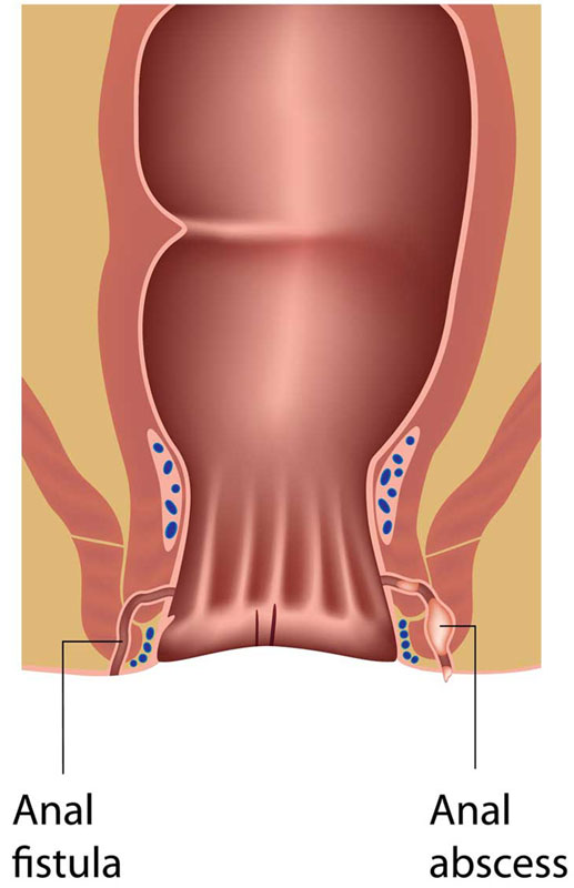 Anorectal abscess