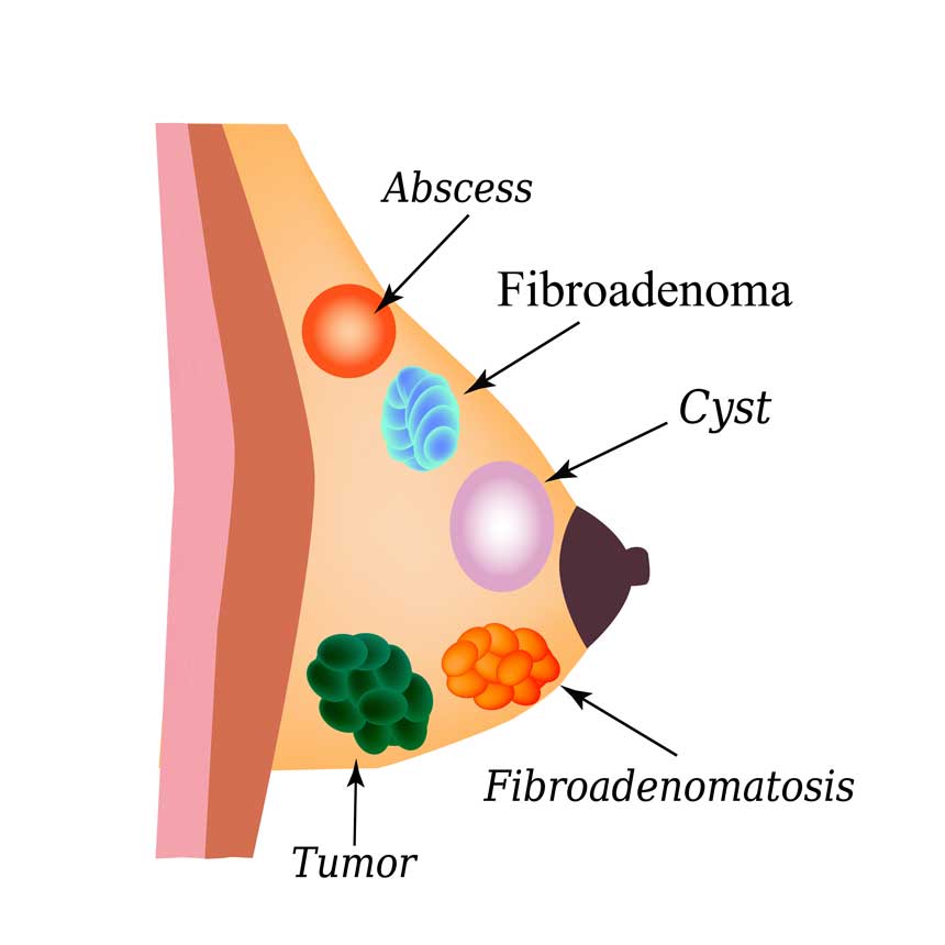 Breast Cysts, Benign Breast Conditions