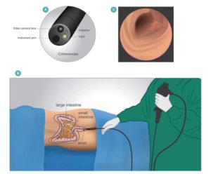 Investigations - Colonoscopy - Dr. Markides