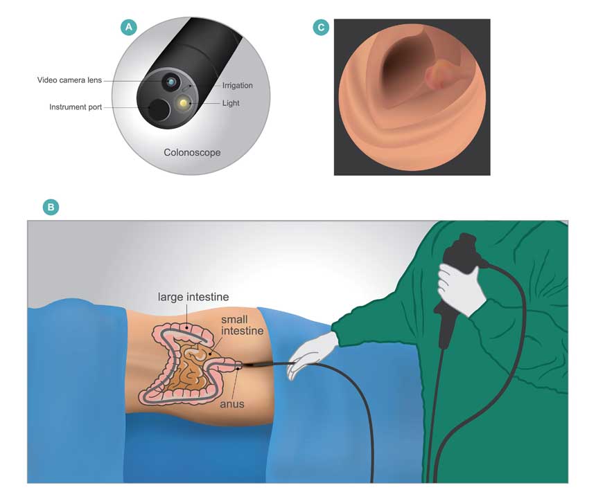 Colonoscopy Plano