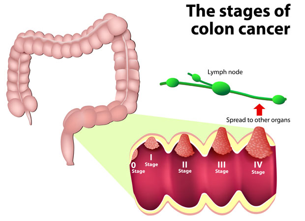 Stages of colon cancer