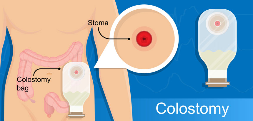 Colostomy diagram