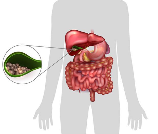 Gallbladder stones