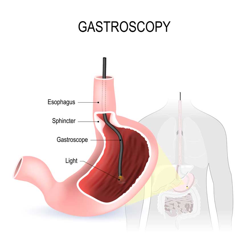 Gastroscopy