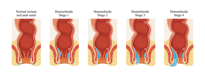 Haemorrhoids