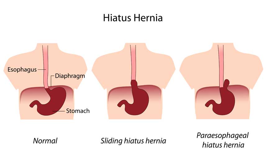 Hiatus hernia