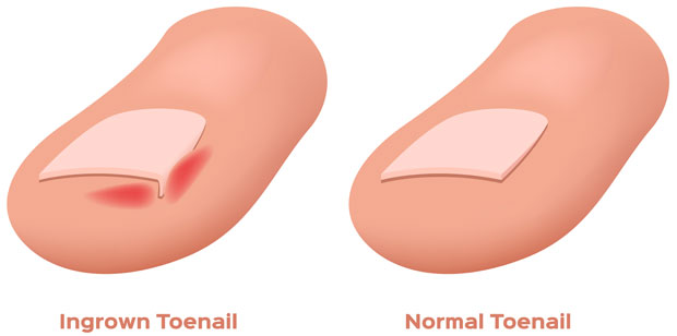 Ingrown toe nail