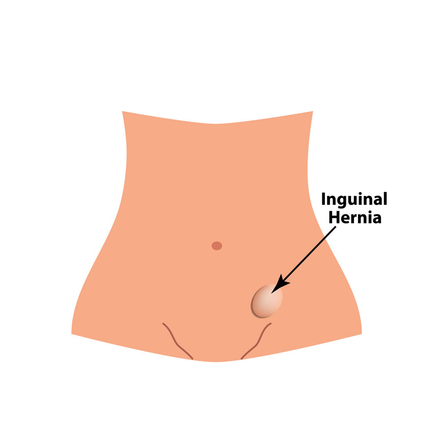 Inguinal hernia & Umbilical hernia
