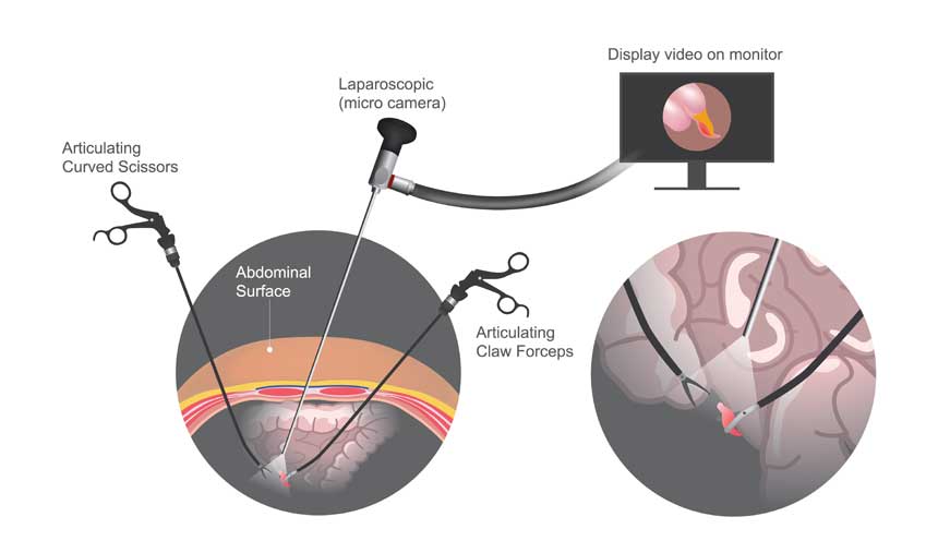 Laparoscopic surgery