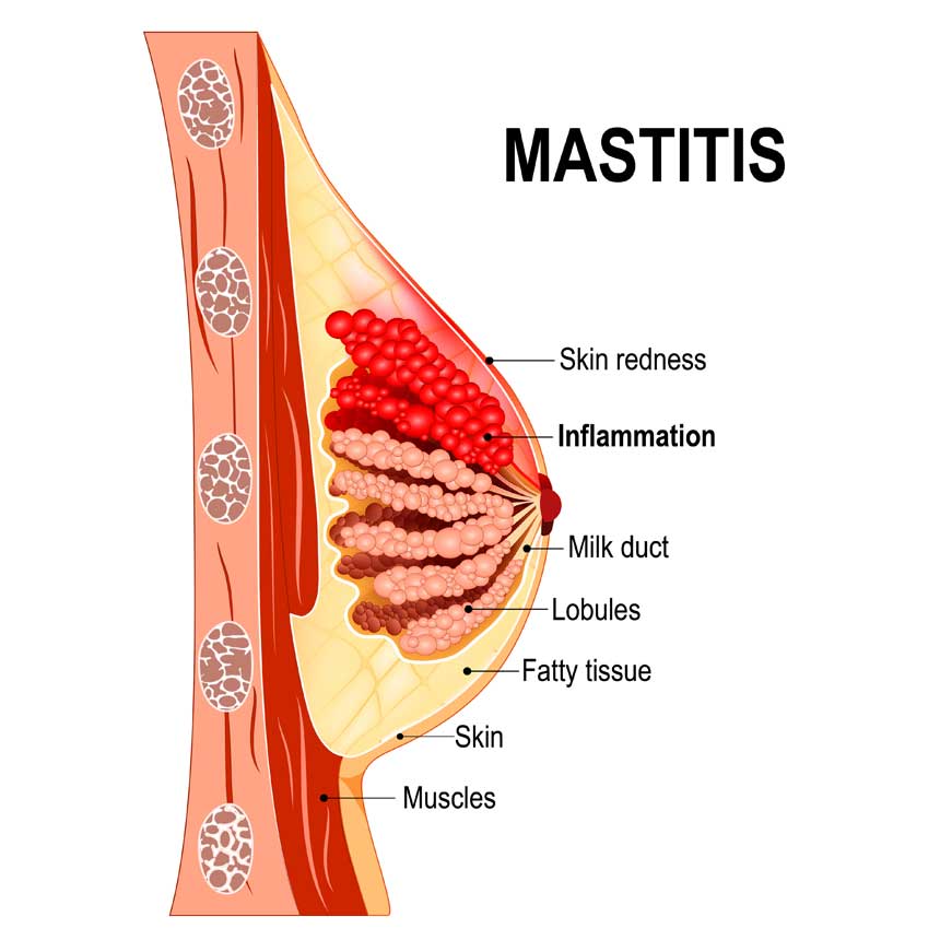 Breast abscess