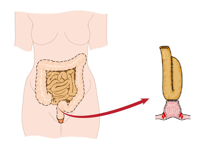 Ileoanal pouch