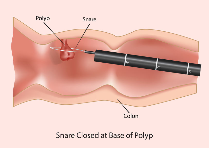 Treatments Polypectomy Emr Dr Markides