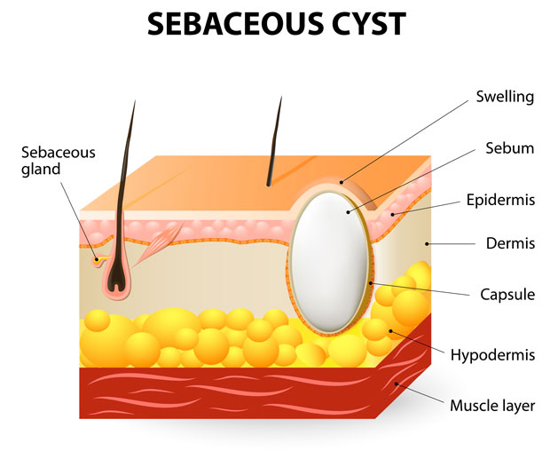 Sebaceous cyst