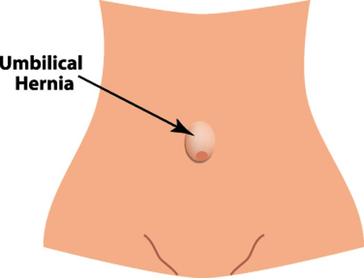 Inguinal hernia & Umbilical hernia