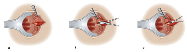 Fissure anal New Protocol