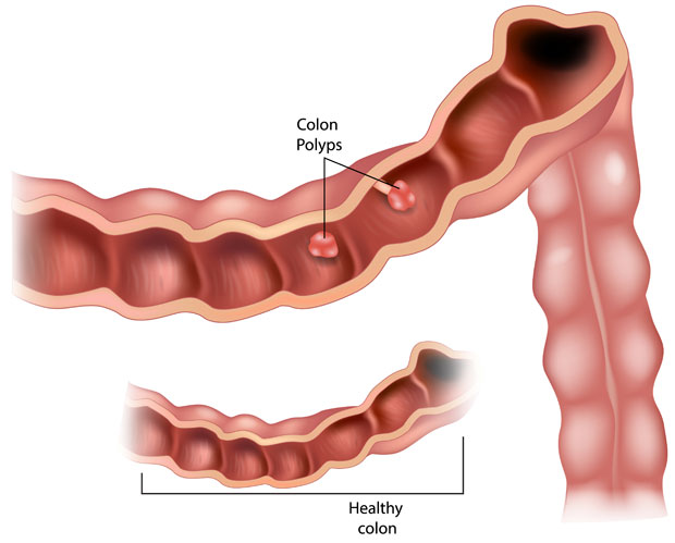 Are Intestinal Polyps Common