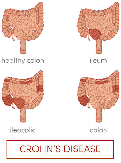 Crohns disease