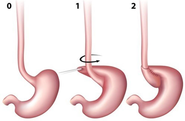 Laparoscopic fundoplication