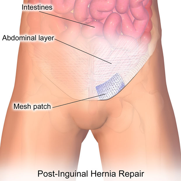 Hernia Repair (Laparoscopic Procedure for Abdominal Hernia)