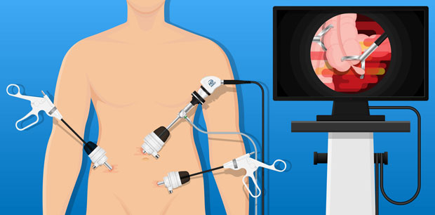 Laparoscopic appendicectomy