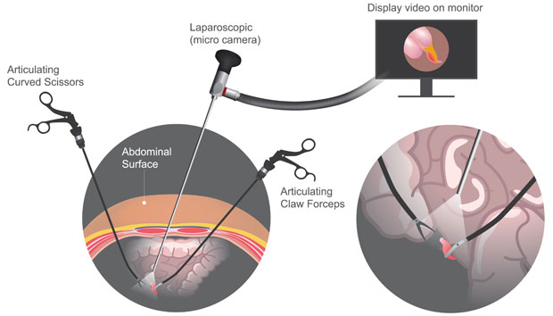 Laparoscopic surgery