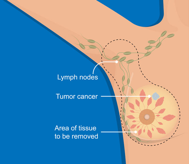 Mastectomy