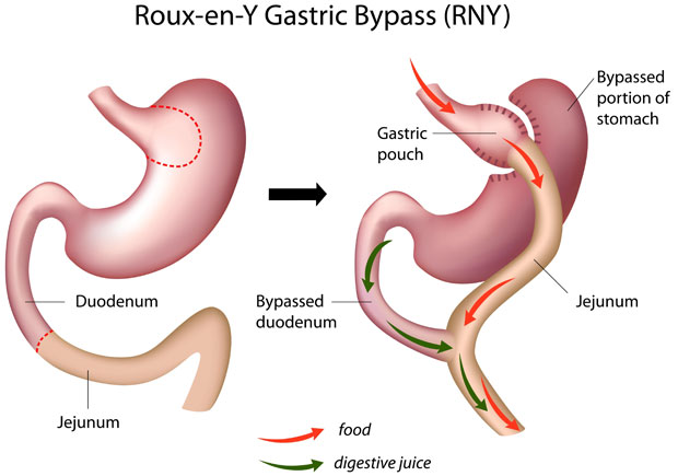 Gastric bypass