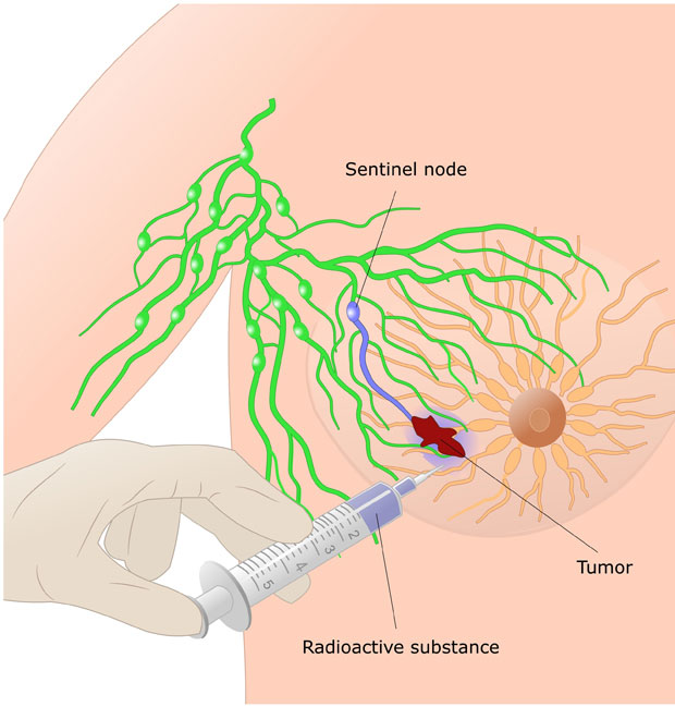 Sentinel lymph node biopsy