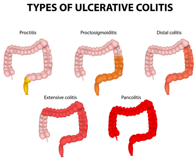 Conditions - Ulcerative colitis and Crohn's - Dr. Markides