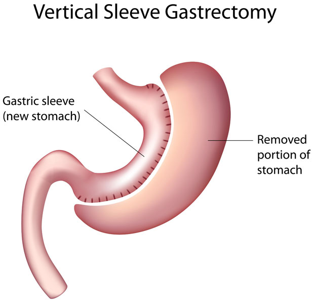 Gastric sleeve