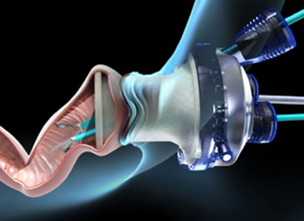 robotic-assisted-trans-anal-minimally-invasive-surgery-less-pain