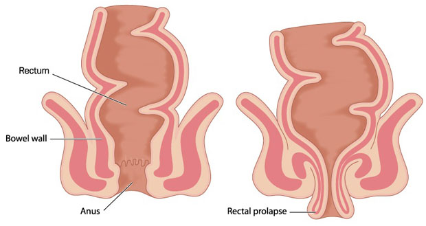 Rectal-prolapse