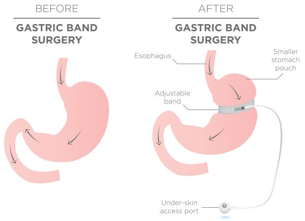 Gastric-band